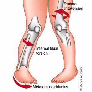 日本女孩走路总是内八，看起来像尿急，没想到是这样的原因！