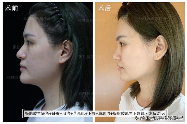 广州27岁美女，泪沟凹陷、鼻唇沟明显，通过脂肪填充能改善吗？