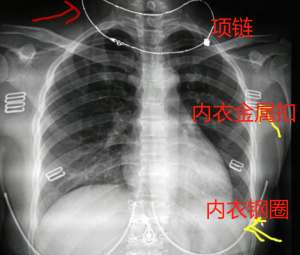 美女奶罩咬脱_长沙美女体检拍胸片，要求脱内衣？医生这样解释