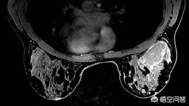 女性应该如何定期检查乳腺，都检查哪些项目？看文此文你就明白了