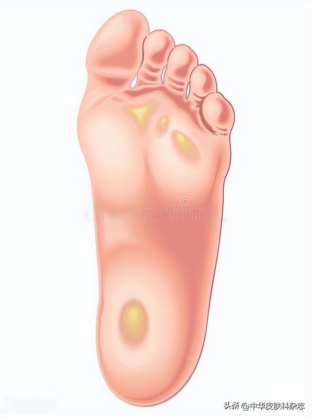 正在折磨你脚底的，是鸡眼、胼胝，还是跖疣？