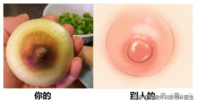 乳晕变化暗示乳腺健康 你会分辨吗