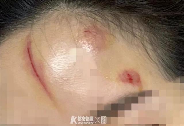 23岁美女模特玩密室逃脱被“鬼”吓到绊倒，脸部划伤缝针，她说：模特靠脸吃饭，损失很大…