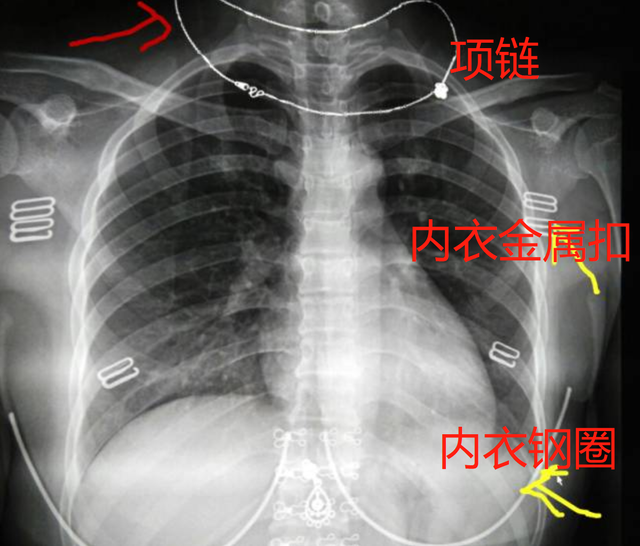 长沙美女体检拍胸片，要求脱内衣？医生这样解释