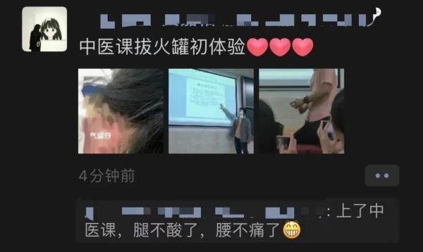 帅气老师给学生拔罐？“头发变多”的秘笈来了