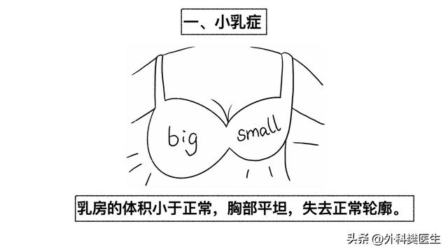 胖小木乳房发育，媳妇觉得太丑让他去整形，他说男人还能乳房整形