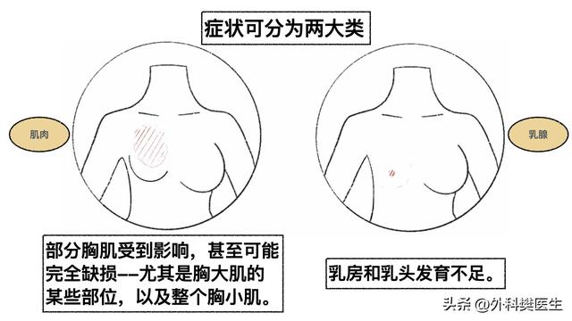 胖小木乳房发育，媳妇觉得太丑让他去整形，他说男人还能乳房整形