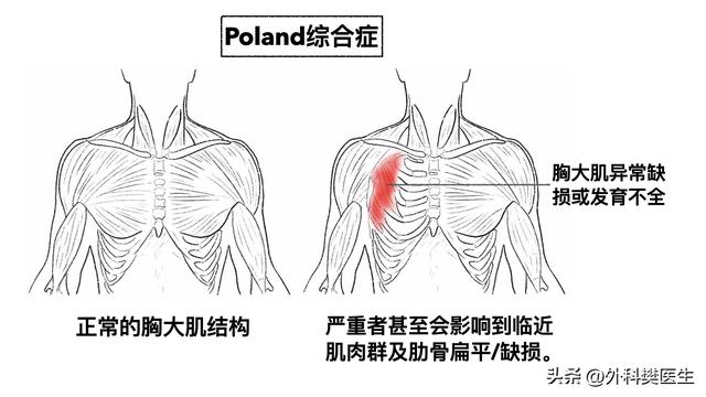 胖小木乳房发育，媳妇觉得太丑让他去整形，他说男人还能乳房整形