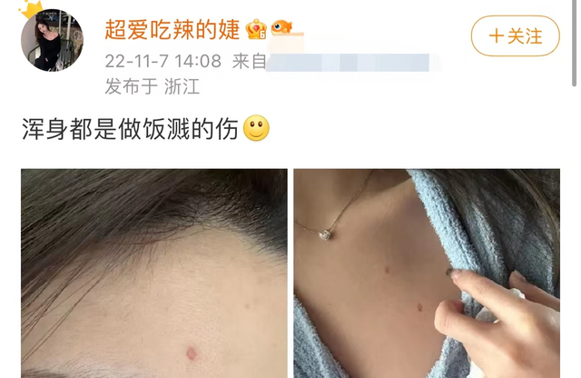 王思聪女友做饭出事故，多处被烫伤，故意扯开衣服露出胸前惹争议