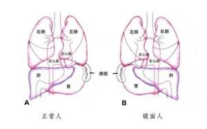 不净观图片美女解剖(发生率百万分之一海南一女子竟是罕见“镜面人” 手术要“反向做”)