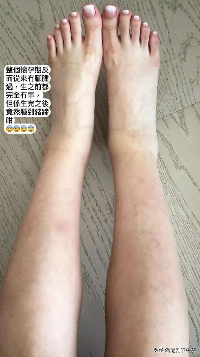 产后双脚肿成猪蹄！TVB美女花旦罕见自爆丑照！称生前身材完美！