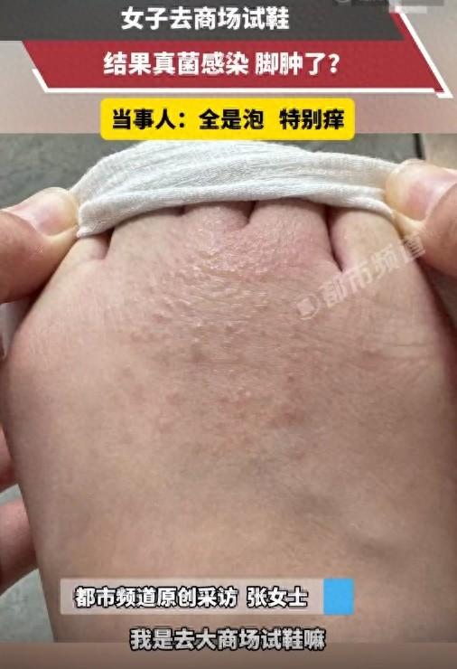 女子试完鞋后瘙痒难耐，密密麻麻全是……