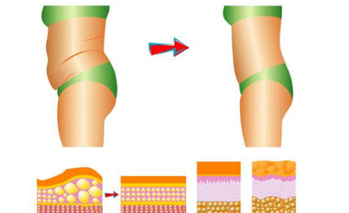 吸脂手术十三问，芒果吸脂的突破点由何而来？